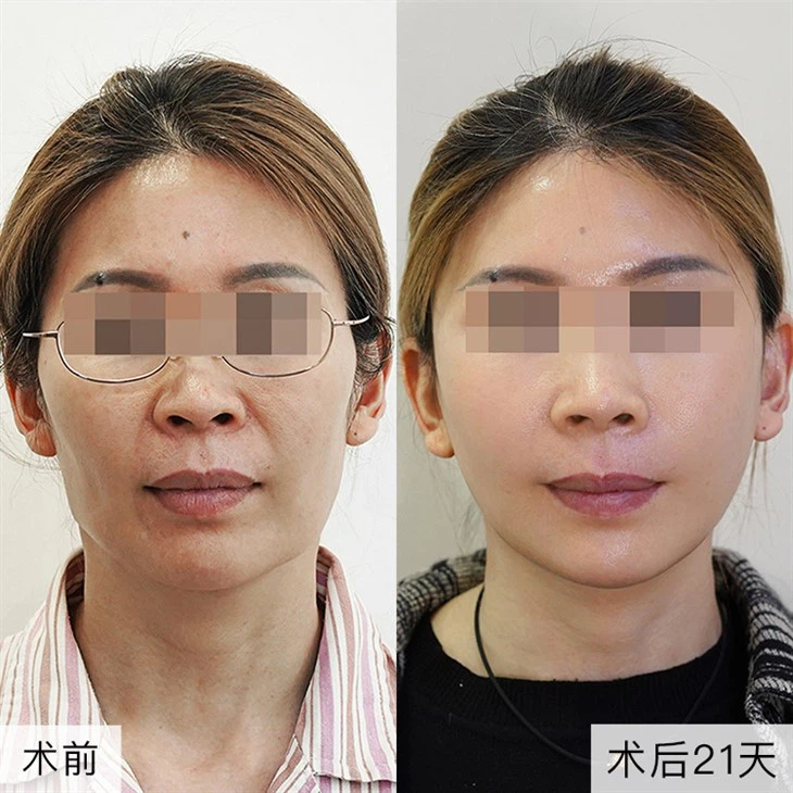 3Jawline Reduction Surgery